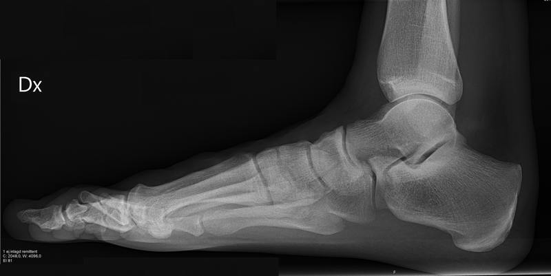 Viêm khớp bàn chân: Triệu chứng và các nguyên nhân thường gặp 6