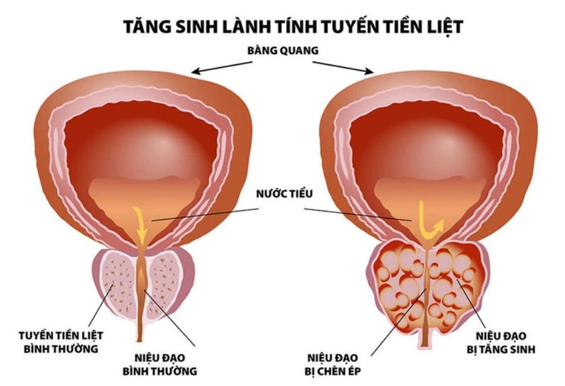 Viêm bể thận 03