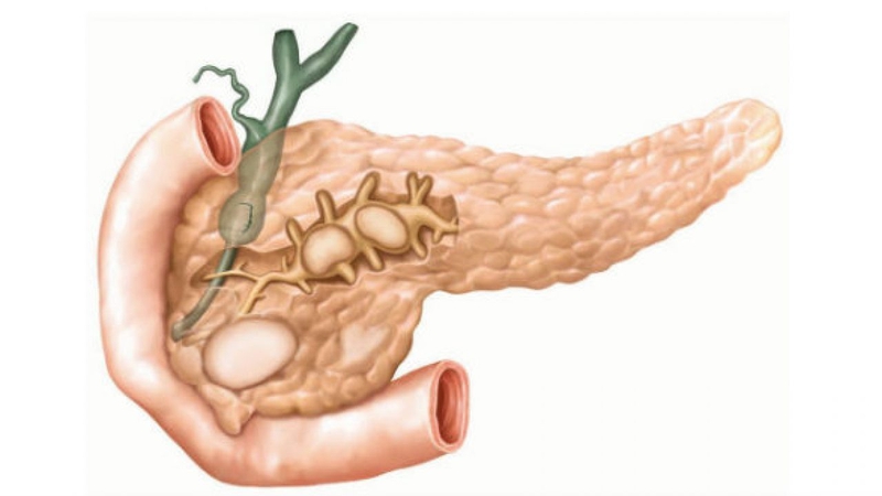 Tìm hiểu về viêm tụy mạn tính xảy ra thế nào? 1