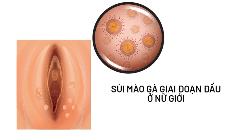 Xét nghiệm nước tiểu có phát hiện sùi mào gà không? Dấu hiệu sùi mào gà là gì? 1