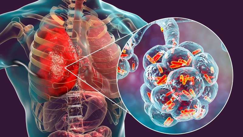 Ai dễ mắc bệnh lao? Phát hiện sớm và điều trị bệnh lao như thế nào? 1