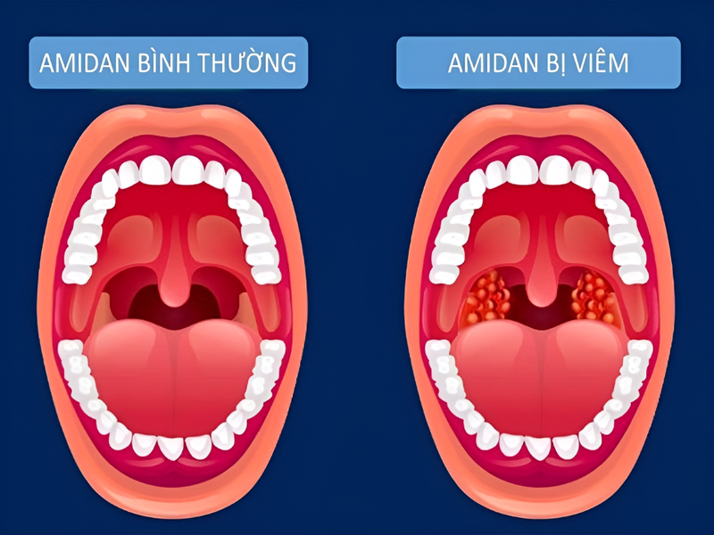 Amidan bình thường là gì? Cách phân biệt amidan bình thường với amidan bị viêm 2