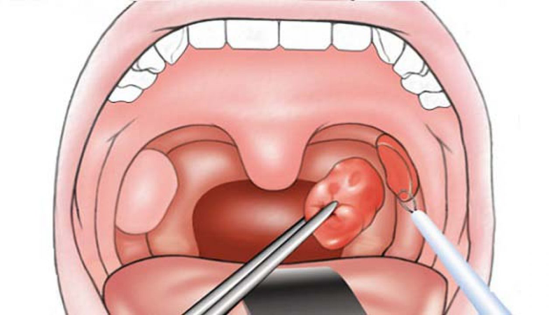 Amidan to bẩm sinh: Nguyên nhân, triệu chứng, cách điều trị 4