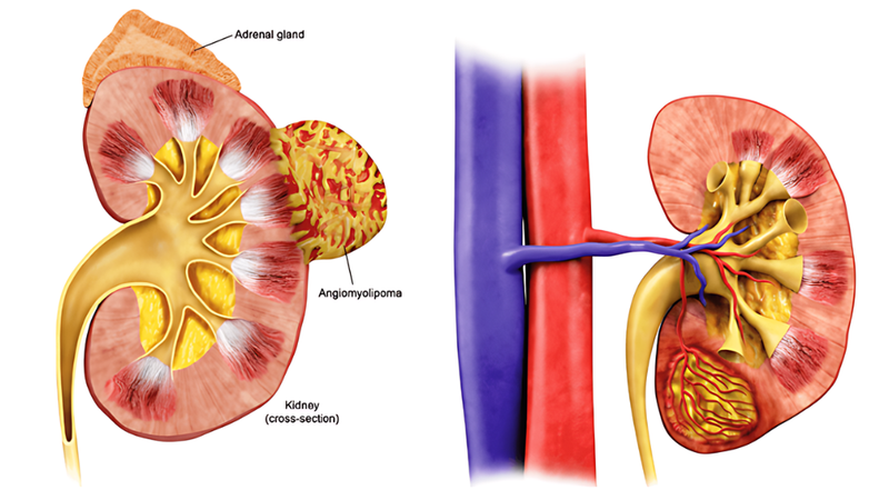 angiomyolipoma-than-la-benh-gi 1