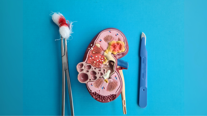 angiomyolipoma-than-la-benh-gi 3