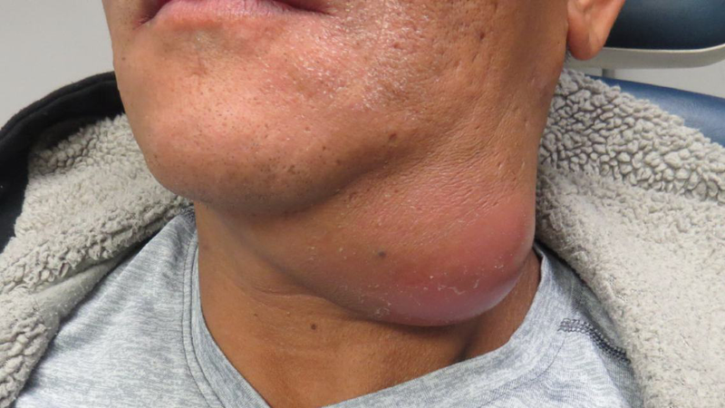 Áp xe cổ: Nguyên nhân, triệu chứng, cách điều trị 2