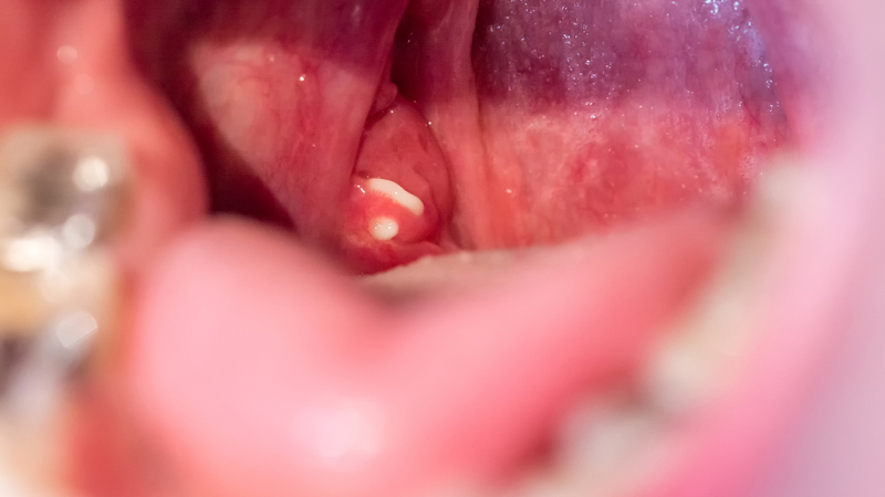 Bã đậu amidan là gì? Nguyên nhân, dấu hiệu và cách điều trị hiệu quả 1