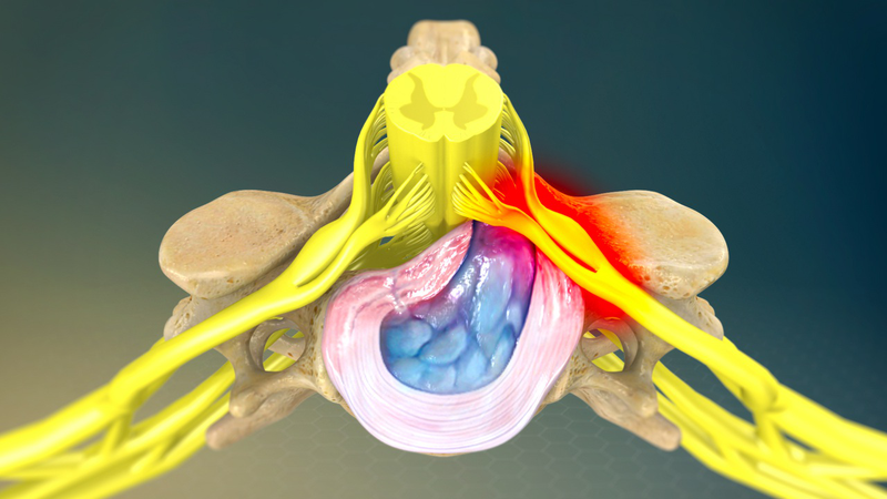 Bác sĩ tư vấn: Thoát vị đĩa đệm có tự khỏi được không? 1