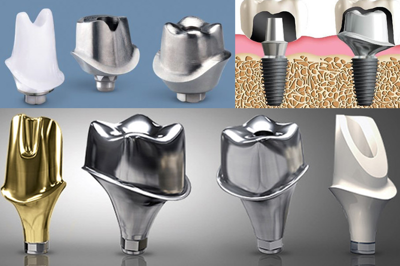 Abutment cá nhân hóa là gì? Chi phí và đối tượng nên cân nhắc sử dụng 2