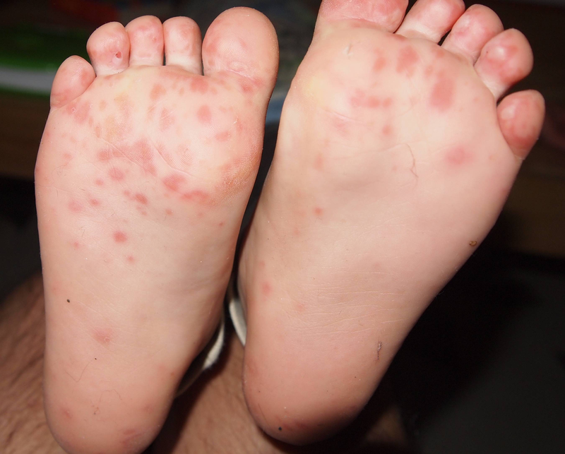 Biểu hiện bệnh sốt phát ban và tay chân miệng? Cách phân biệt tránh gây nhầm lẫn 4