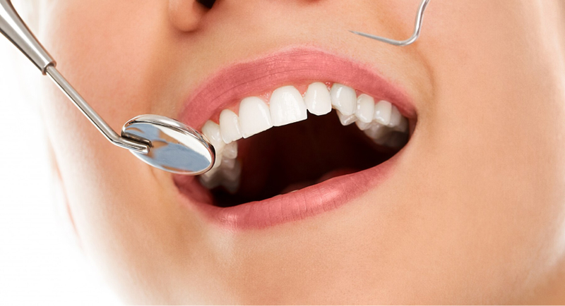 Bọc răng sứ có phải nhổ răng không? Những trường hợp ngoại lệ cần lưu ý 4