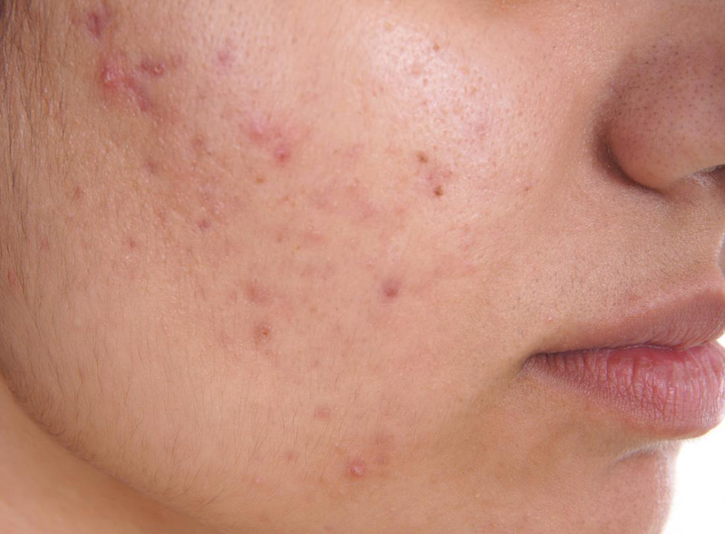Cách phân biệt viêm nang lông và mụn trứng cá​ để điều trị hiệu quả 2