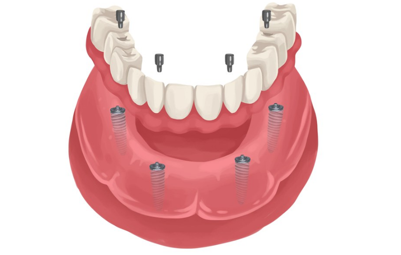 Cấy ghép implant 7 phút không đau có thật không? Hiệu quả ra sao? 5