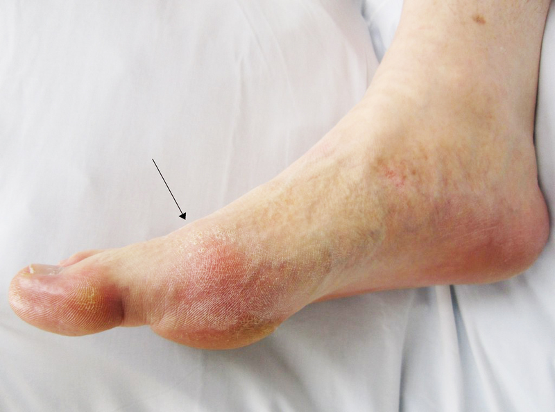 Chỉ số axit uric 450​ là đã bị gout chưa? Cách phòng tránh nồng độ axit uric tăng cao 1