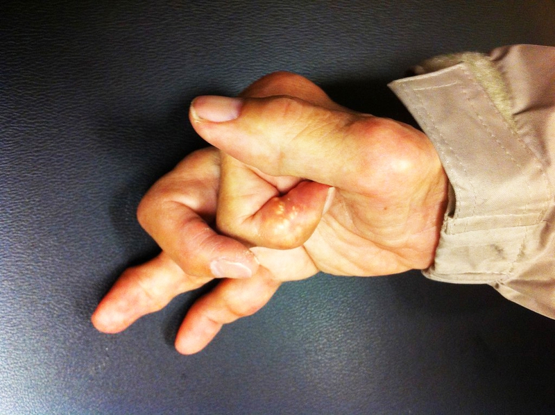 Chỉ số axit uric 450​ là đã bị gout chưa? Cách phòng tránh nồng độ axit uric tăng cao 2