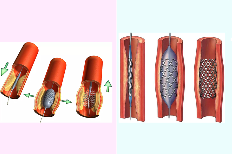 Đặt stent nhồi máu cơ tim khi nào được chỉ định? Có rủi ro hay không? 2
