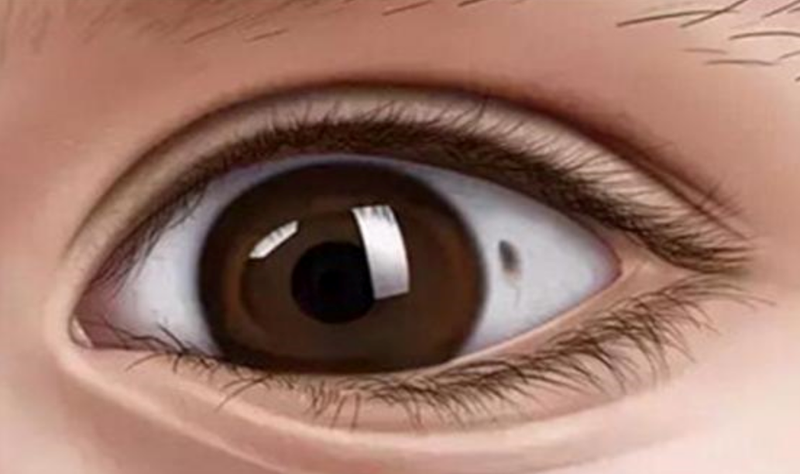 Đốm nâu trong mắt là gì? Do những nguyên nhân nào gây ra? 2