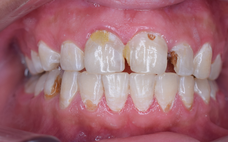 Gel làm trắng răng có thực sự tốt không? Những lưu ý khi sử dụng  2