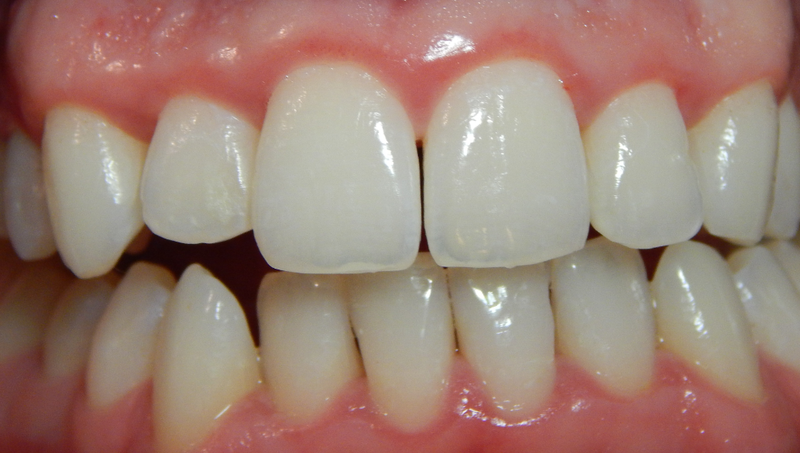 Gel làm trắng răng có thực sự tốt không? Những lưu ý khi sử dụng  4