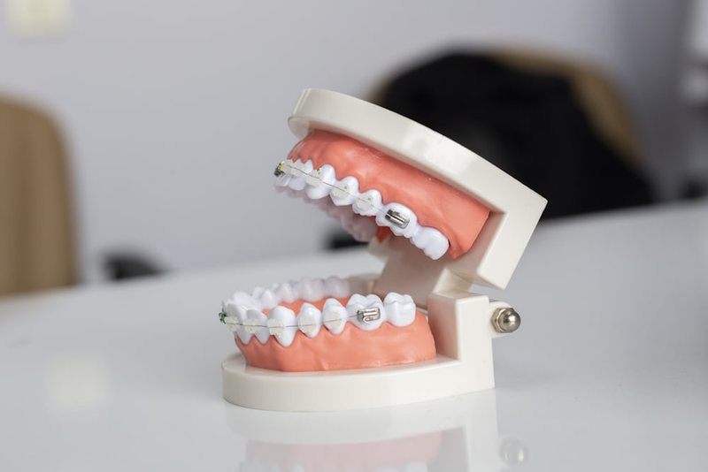 Giá niềng răng mắc cài sứ là bao nhiêu? Ưu, nhược điểm của niềng răng mắc cài sứ 2