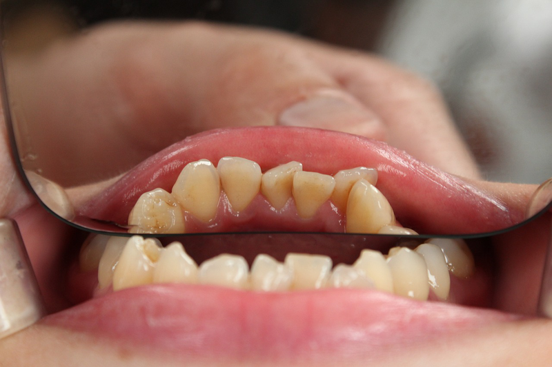 Giá răng sứ zirconia có cao không? Ưu, nhược điểm của răng sứ zirconia 2 