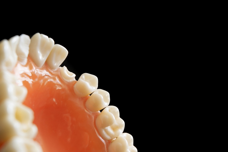 Hàn răng thưa là gì? Hướng dẫn chăm sóc răng miệng sau khi hàn răng thưa 3