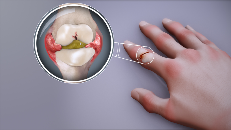 Hiểu cơ chế viêm khớp dạng thấp để kiểm soát bệnh hiệu quả 2