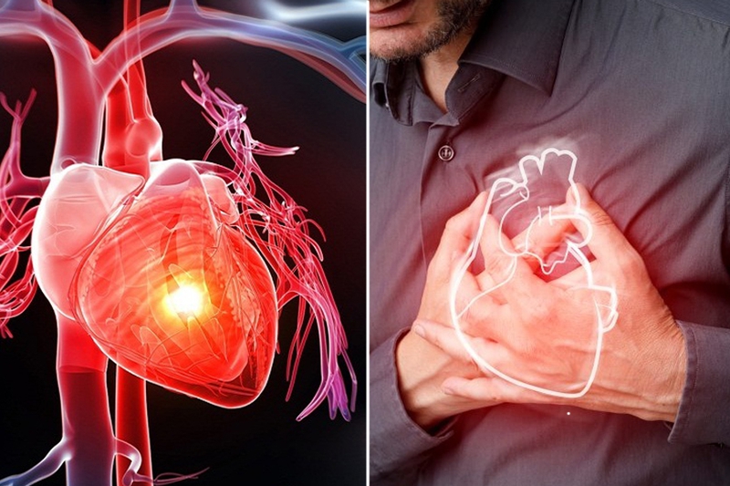 Nguyên nhân và cơ chế gây nhồi máu cơ tim?  Cách ngăn ngừa, phòng bệnh hiệu quả 2