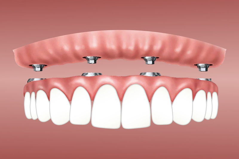 Những biến chứng sau khi trồng răng Implant bạn cần biết 2