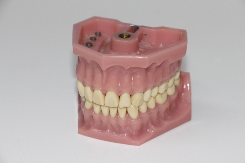 Những biến chứng sau khi trồng răng Implant bạn cần biết 3