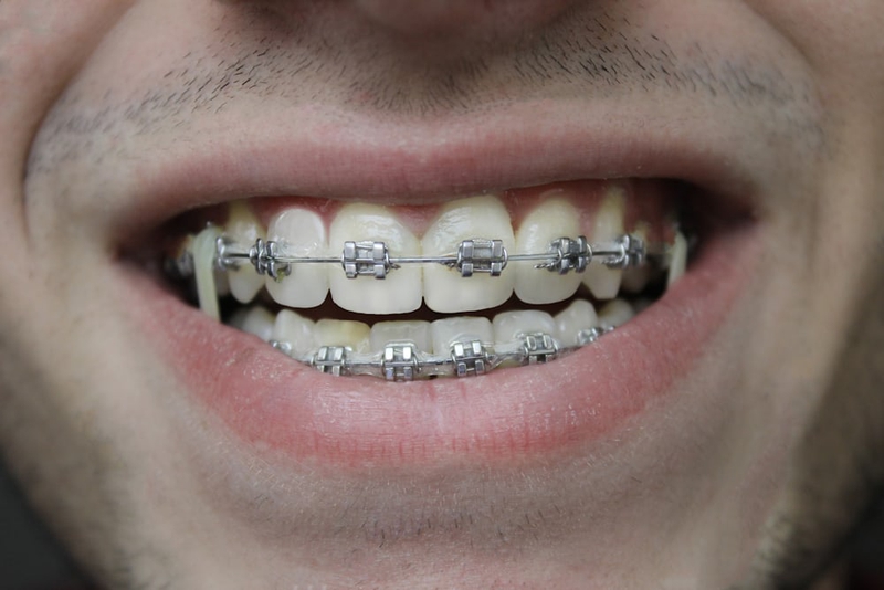 Những lưu ý khi niềng răng ai cũng cần biết 1