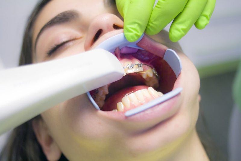 Những lưu ý khi niềng răng ai cũng cần biết 2