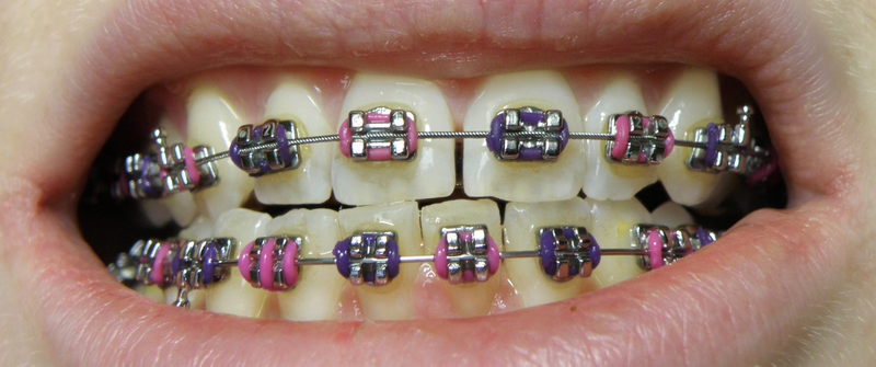 Niềng răng 1 cái có được không? Giải pháp khắc phục tình trạng 1 răng lệch 1