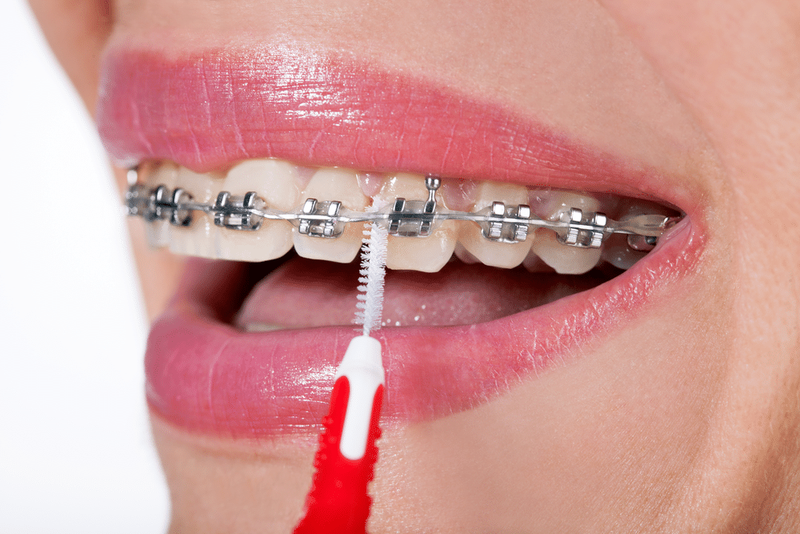Niềng răng là gì? Chia sẻ kinh nghiệm niềng răng hiệu quả nhất 3