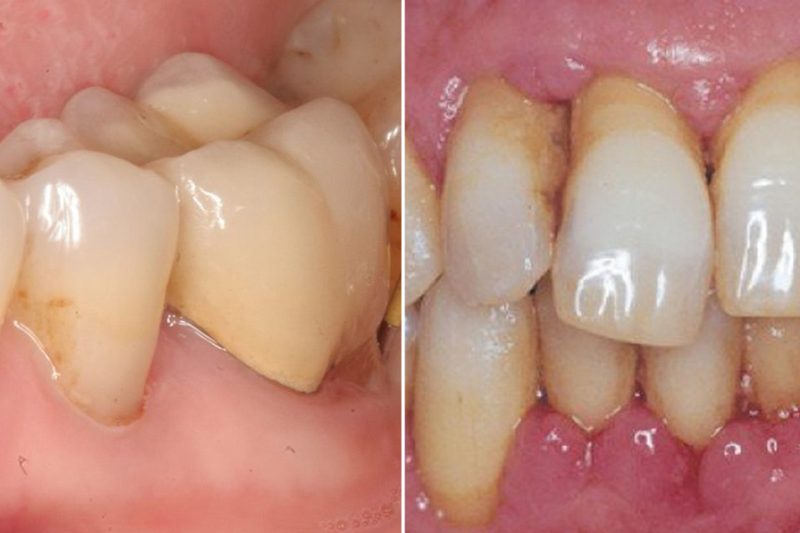 Phẫu thuật lật vạt là gì? Ai nên và không nên thực hiện phương pháp này? 1