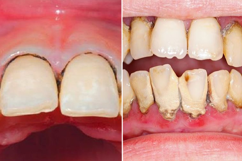 Phẫu thuật lật vạt là gì? Ai nên và không nên thực hiện phương pháp này? 2