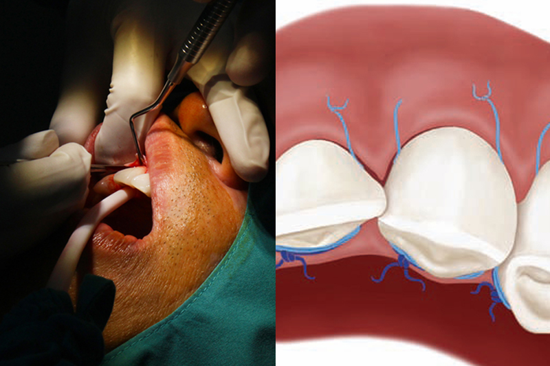 Phẫu thuật lật vạt là gì? Ai nên và không nên thực hiện phương pháp này? 4