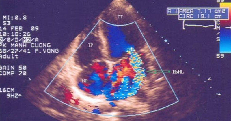 Siêu âm Doppler tim là gì? Kết quả siêu âm cho thấy điều gì? 4