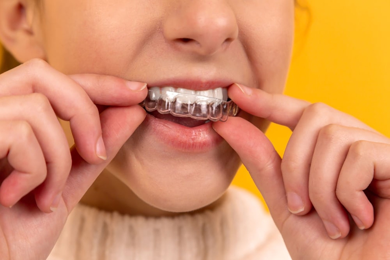 Tìm hiểu các loại mắc cài trong niềng răng, ưu và nhược điểm từng loại mắc cài 3