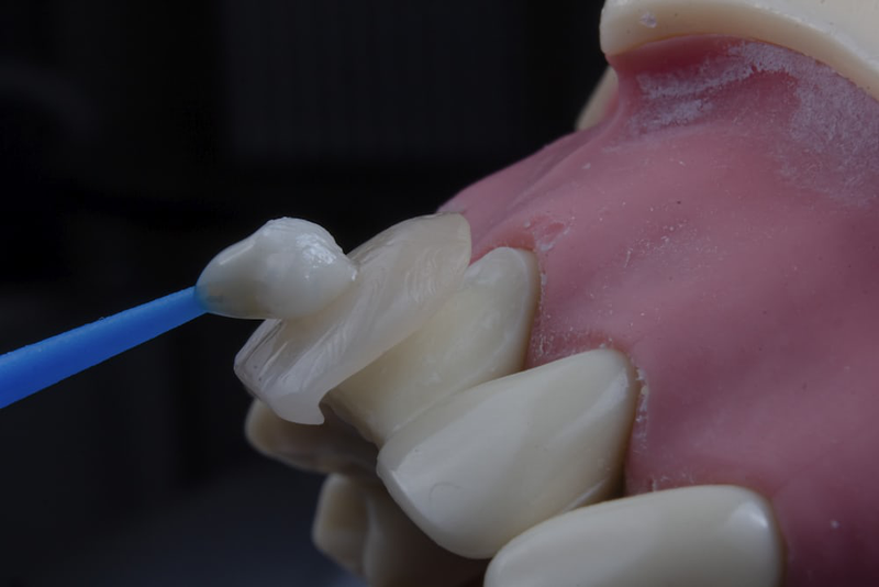 Trồng răng Implant có vĩnh viễn không? 3