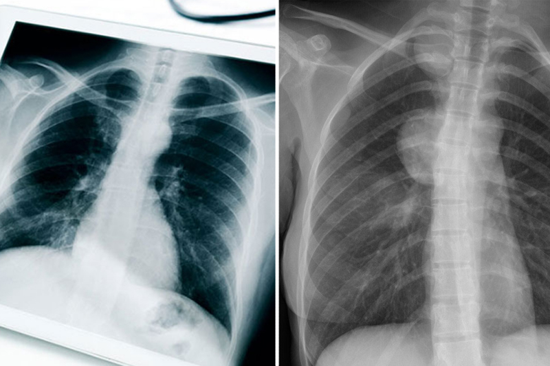 U trung thất ác tính sống được bao lâu? Cách điều trị và phòng ngừa 2