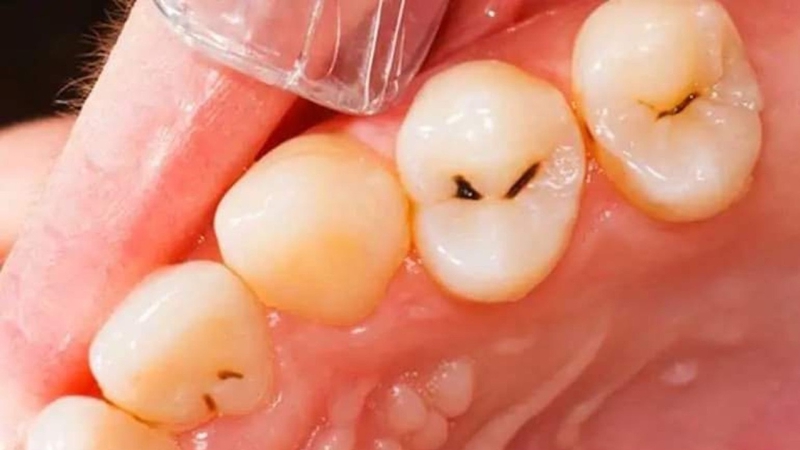 Bạn có biết răng đã lấy tủy tồn tại được bao lâu 1