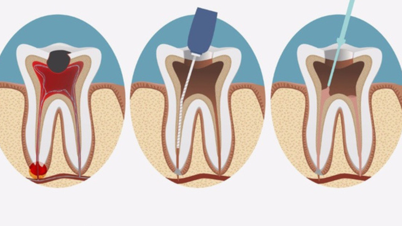 Bạn có biết răng đã lấy tủy tồn tại được bao lâu 2