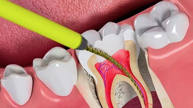 Bạn có biết răng đã lấy tủy tồn tại được bao lâu