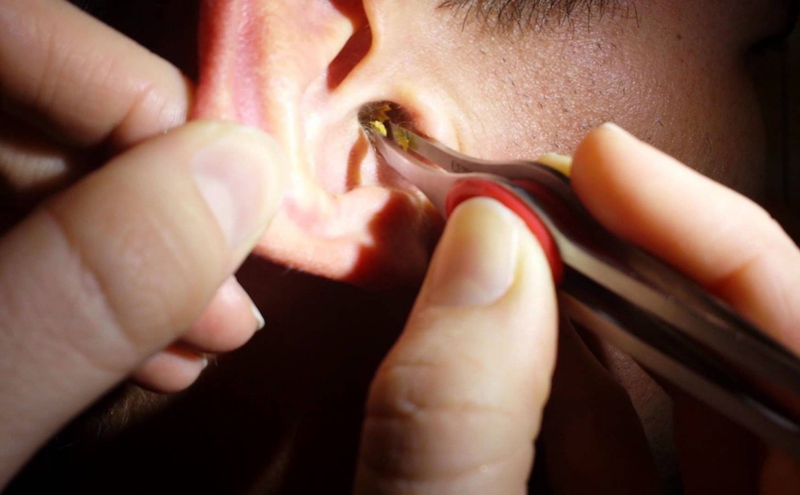 Bạn đã biết cách vệ sinh tai khi bị chảy mủ hiệu quả? 3