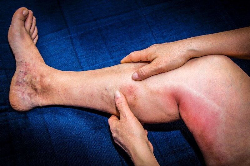 Bắp chân có cảm giác nóng là dấu hiệu của bệnh gì 2