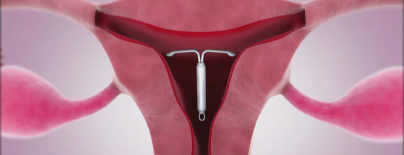Bật mí các loại vòng tránh thai và những lưu ý khi đặt vòng tránh thai 3