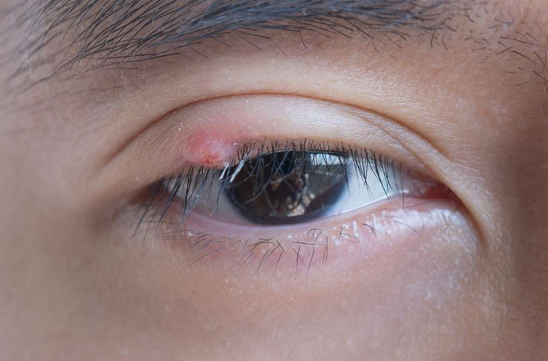 Bật mí cách phân loại mạch máu mí mắt và phương pháp điều trị 1