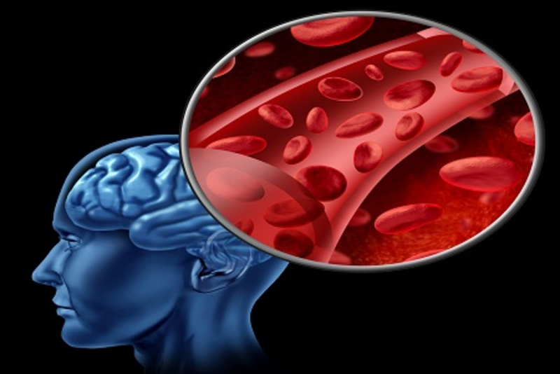 Bật mí dấu hiệu nhồi máu cơ não phổ biến thường gặp ở người lớn tuổi 2
