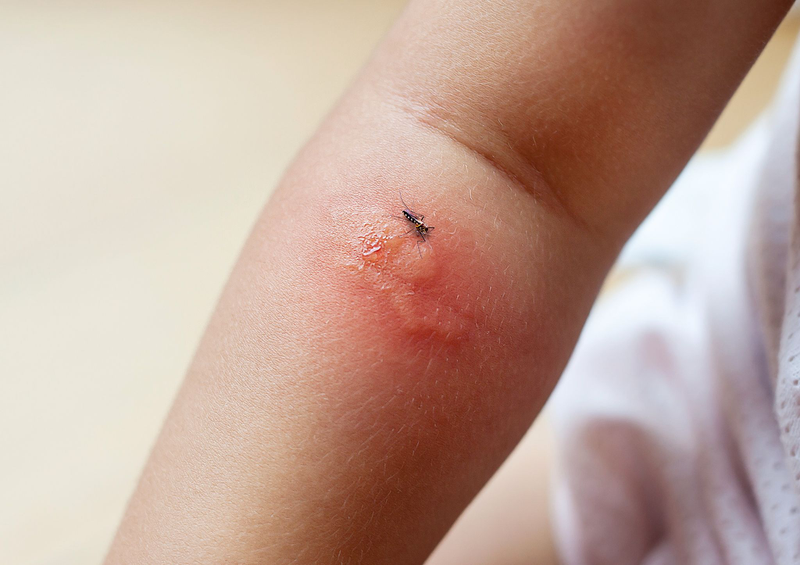 Bé bị muỗi đốt dễ dàng nhận biết qua biểu hiện ngoài da